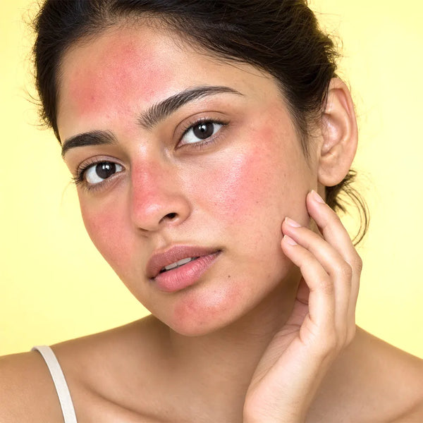 Sunburn