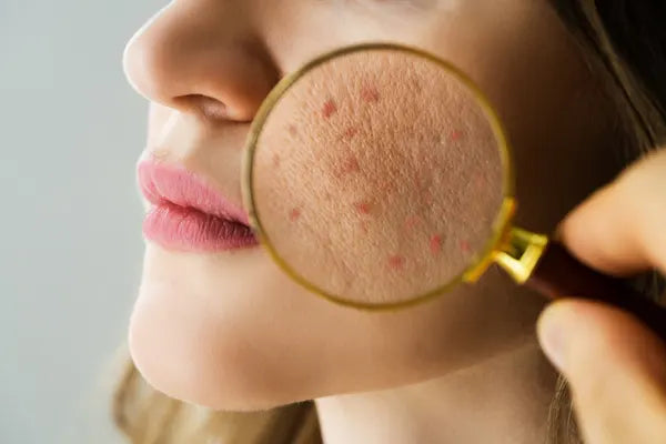 Damaged Skin Barrier