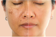 Pigmentation