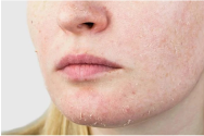Dry Skin
